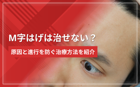 【手遅れ?】M字はげは治せない?原因と進行を防ぐ治療方法を紹介