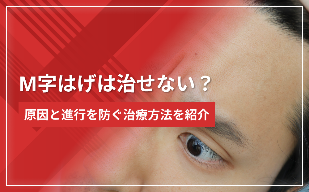 【手遅れ?】M字はげは治せない?原因と進行を防ぐ治療方法を紹介