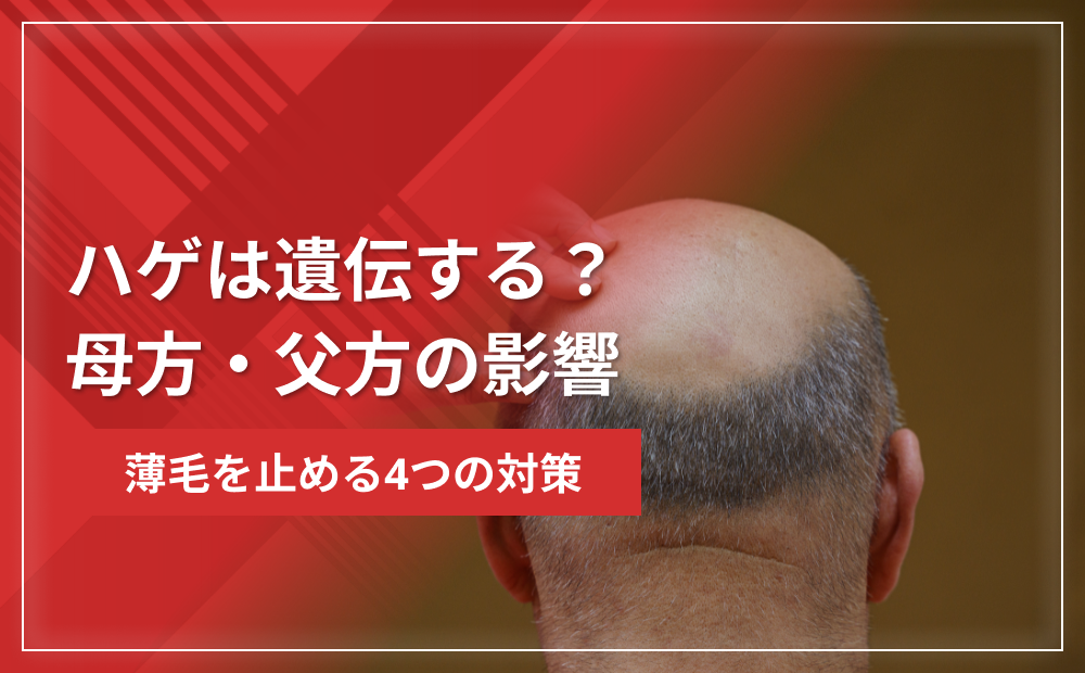 ハゲは遺伝する？母方・父方の影響と薄毛を止める4つの対策