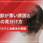頭頂部が薄い原因とAGAの見分け方｜放置リスクと治療法を解説