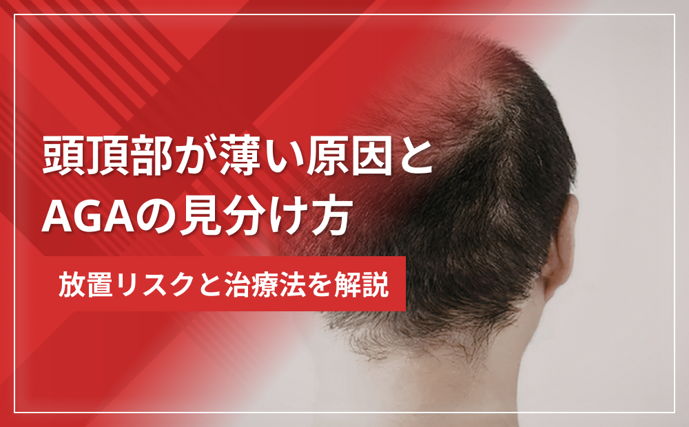 頭頂部が薄い原因とAGAの見分け方｜放置リスクと治療法を解説