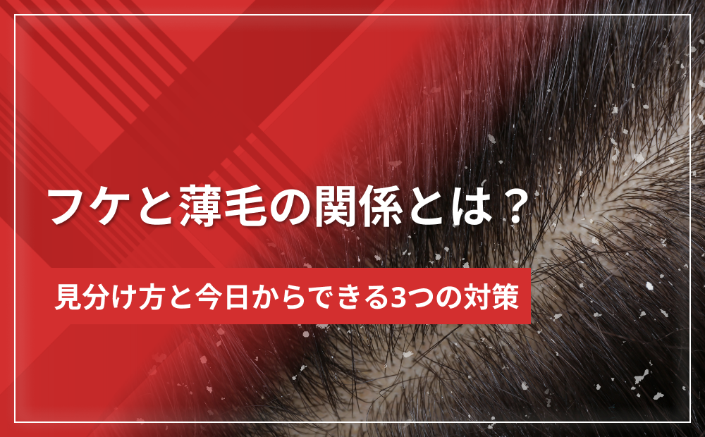 フケと薄毛の関係とは?原因の見分け方と今日からできる3つの対策